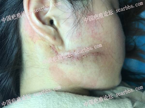 9.29杨教授处做的面部疤痕疙瘩切除手术 