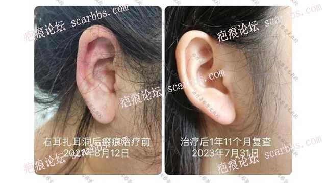 蔡景龙教授疤痕治愈案例分享：耳部瘢痕疙瘩案例 