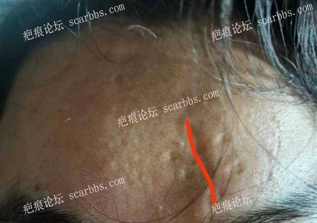 23.7.14选择重庆东上修复了额头凹陷疤痕
