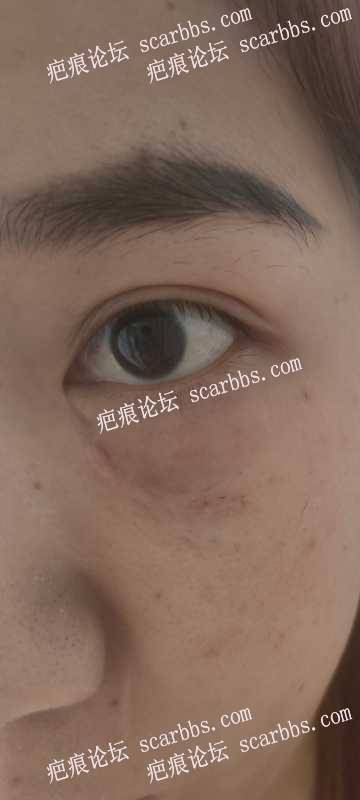 4月26日杨教授手术切除眼睛下边疤痕 