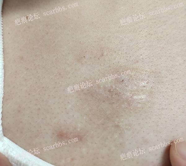 天津小陈前胸4年疤痕疙瘩治疗案例 