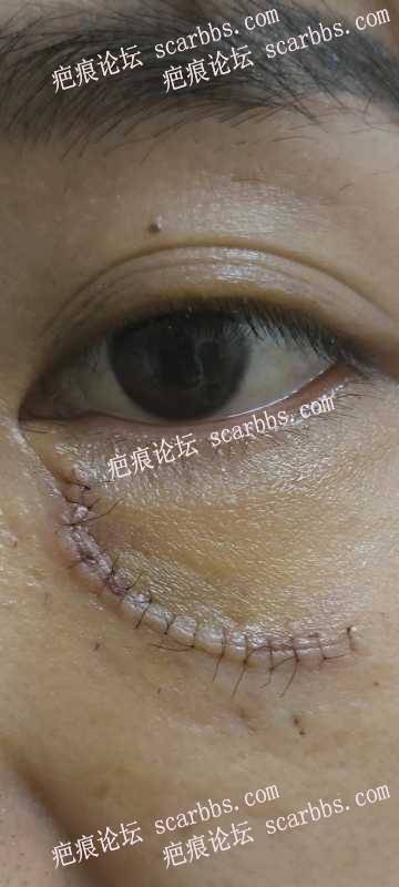 4月26日杨教授手术切除眼睛下边疤痕