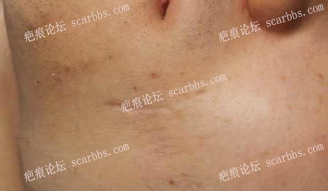2023年4月6日在重庆东上找杨东运教授做了凹陷疤痕修复 
