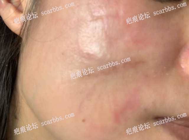 面部疤痕2月15日在杨教授那做了疤痕修复 