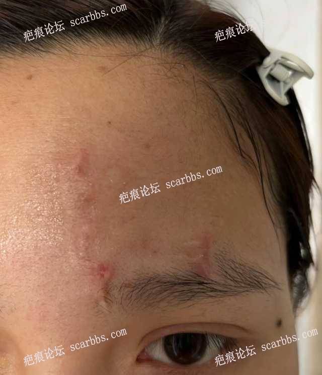 额头疤痕今天在重庆东上找杨教授做了疤痕修复！ 