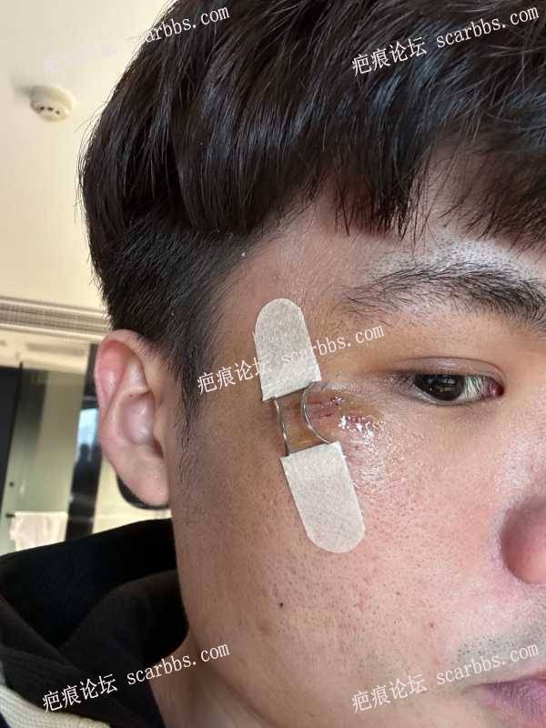 脸上摔伤造成的色素凹陷疤痕2023.3.10做了切缝和填充分享 