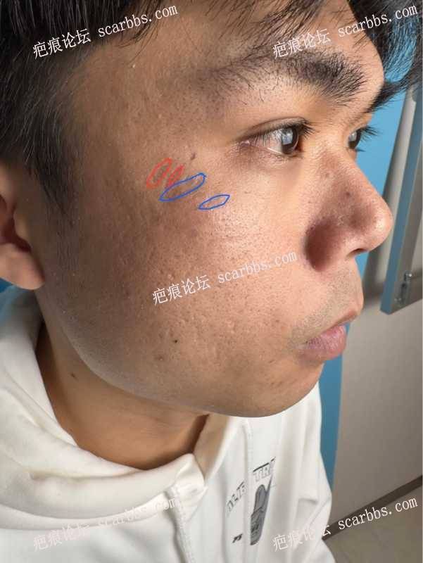脸上摔伤造成的色素凹陷疤痕2023.3.10做了切缝和填充分享 
