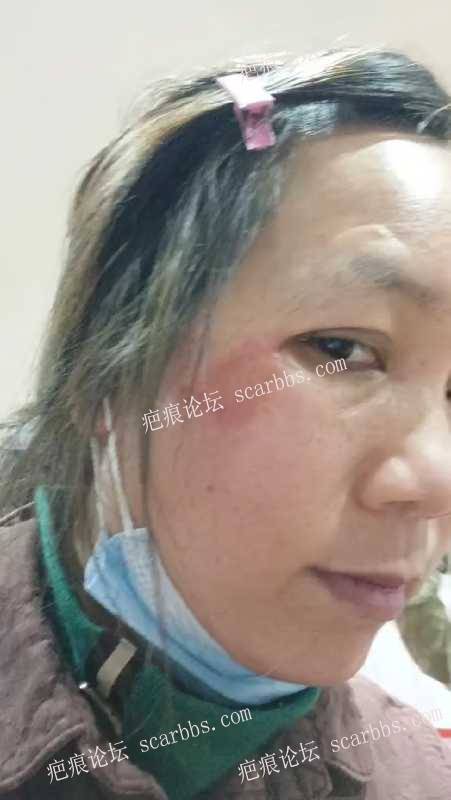 眼睛侧面植皮色素疤痕在郑州医德佳第二次手术修复 
