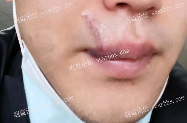 记录北京八大处臧梦青医生嘴唇疤痕切缝恢复过程