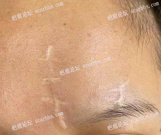 额头疤痕今天在重庆东上找杨教授做了疤痕修复！ 