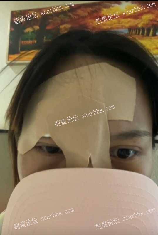 额头疤痕今天在重庆东上找杨教授做了疤痕修复！