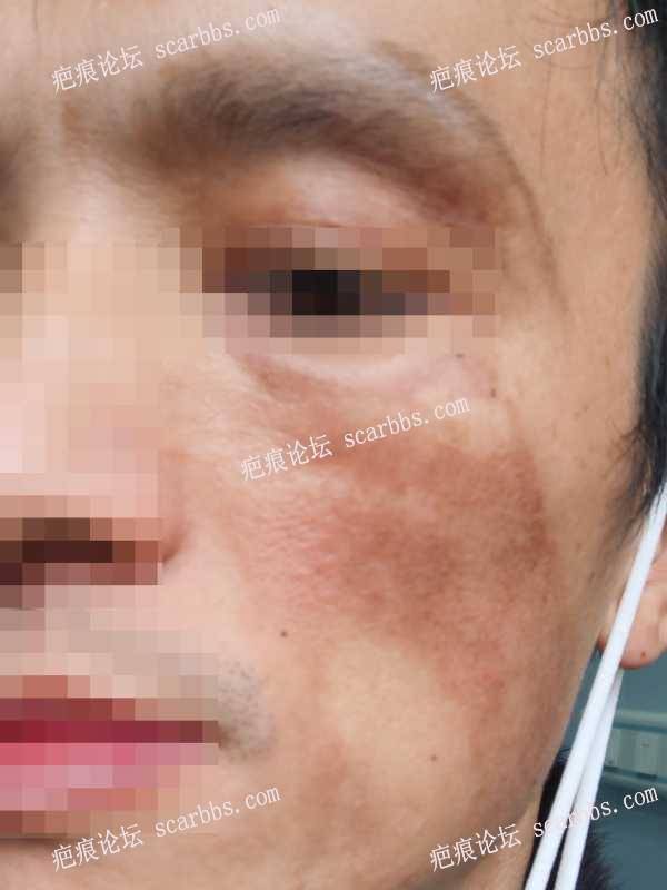 【面部烧烫伤】意外导致面部严重烫伤，治疗2个多月明显改善，预防色素沉着 
