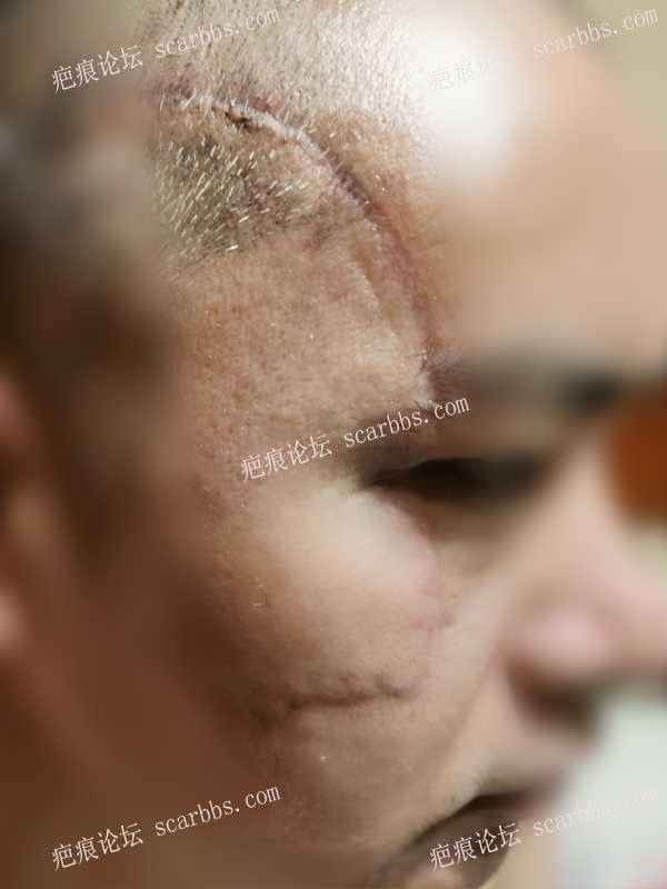 刀伤手术缝合拆线后，如何护理能尽量控制疤痕 