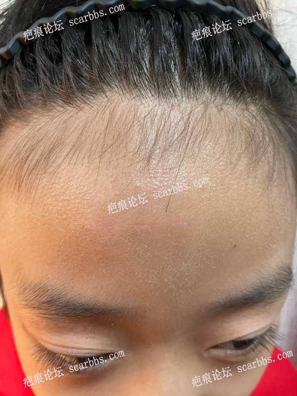 2023.7.18 十岁孩子在东上医疗汤院长额头横疤切缝治疗反馈 