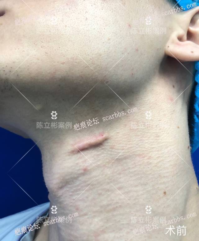 颈部增生疤痕患者术后4月反馈 