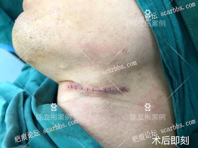 颈部增生疤痕患者术后4月反馈 