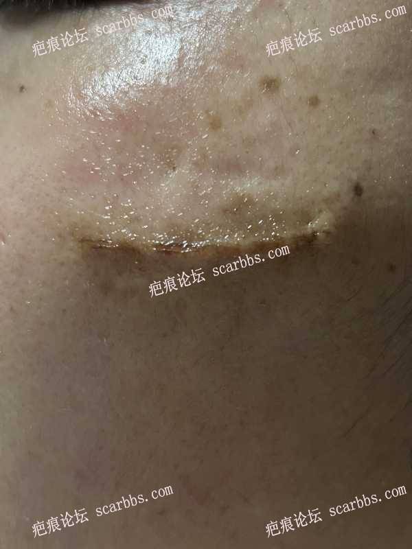 脸上多年凹陷疤痕，2023年9月30日杨东运教授手术 