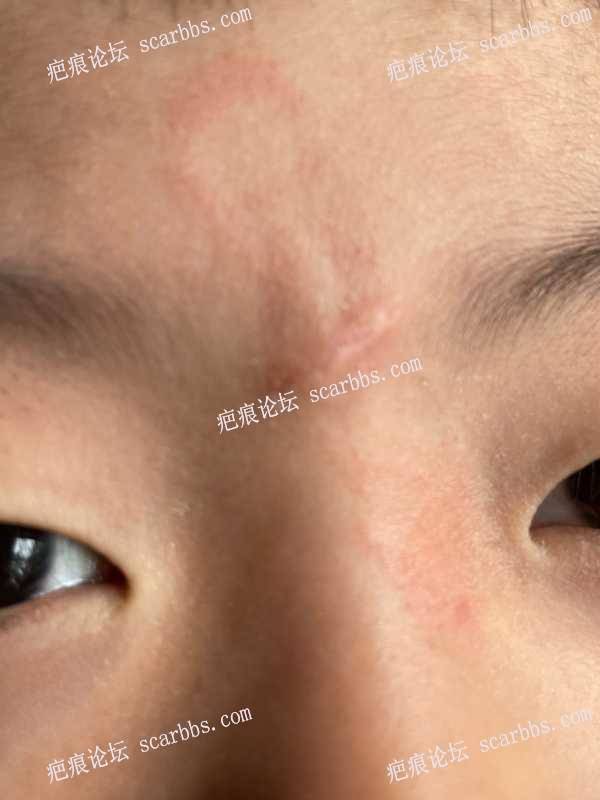 儿童凹陷疤痕，切缝精细缝合后恢复记录 