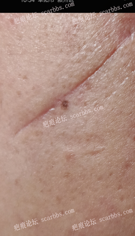 疤痕切除快两个月了 缝隙明显怎么办