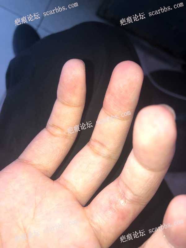 手指上的疤痕做了切除手术 