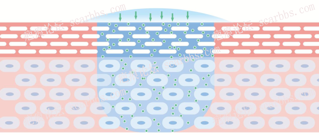 硅酮真的能抑制疤痕吗？ 