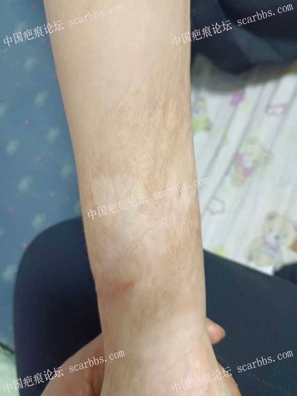 5岁烧伤疤痕，0629在杨教授处做手术+激光治疗 