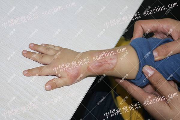 山东小尉手臂烫伤疤痕增生治疗案例 