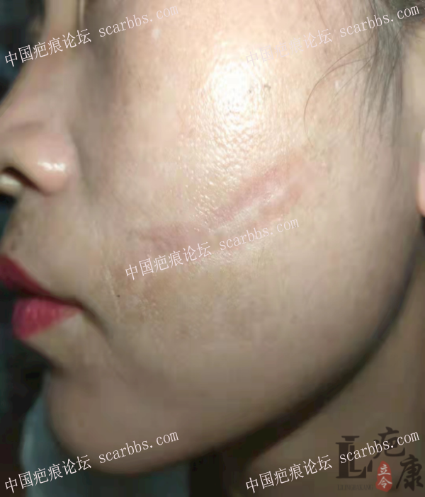 脸部凹陷疤痕治疗案例分享 