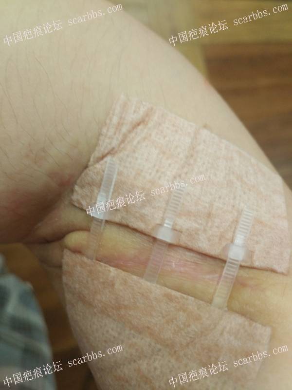 右手臂烫伤疤痕：上海NO.9治疗+最真实的分享+全过程记录+亲身体验 