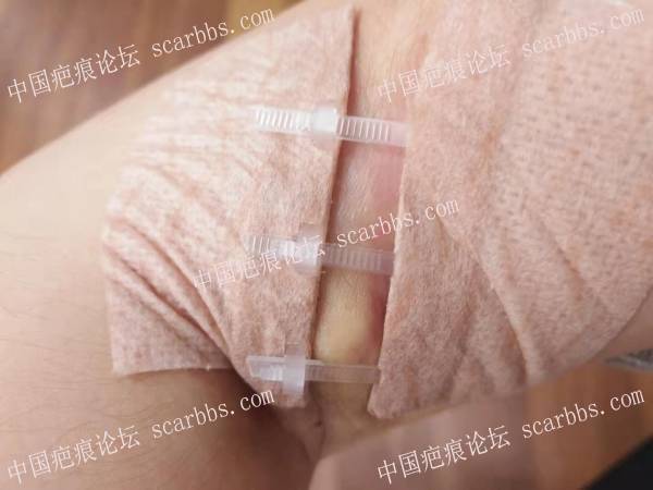 右手臂烫伤疤痕：上海NO.9治疗+最真实的分享+全过程记录+亲身体验 