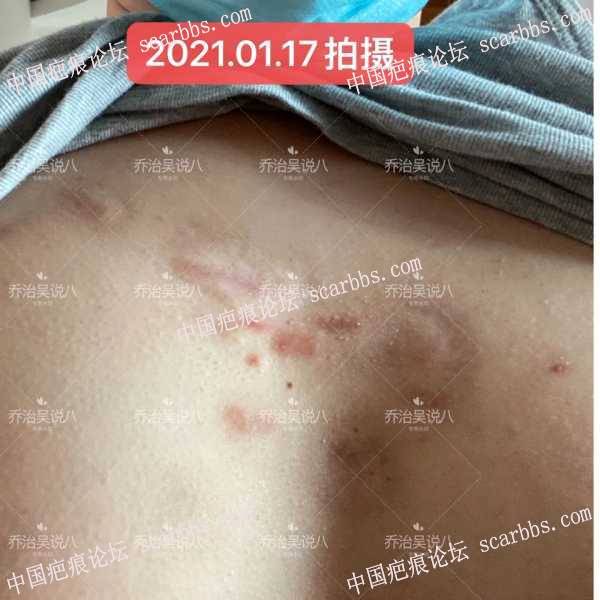 疤痕体质引发15年老疤痕疙瘩被治愈经验，毫无保留分享！！ 