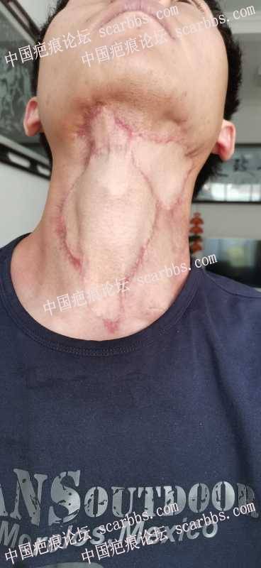 颈部手术术疤痕，第一次离子束后20天，大家觉得有效果吗 