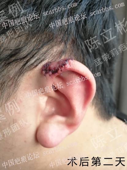 耳部疤痕疙瘩术后1年复诊记录 耳部疤痕疙瘩,手术切除,术后放疗,加压护理