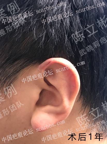 耳部疤痕疙瘩术后1年复诊记录 耳部疤痕疙瘩,手术切除,术后放疗,加压护理