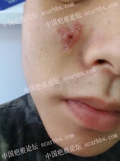 面部痘坑疤痕在天津时光整形切除了 