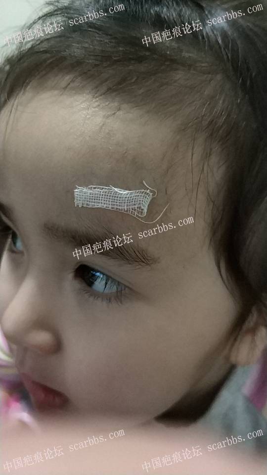 宝贝1.7额头磕着暖气片缝6针，疤痕后续护理 额头磕伤,缝针疤痕,记录护理
