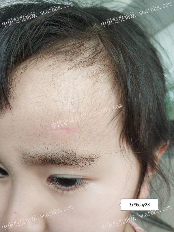宝贝1.7额头磕着暖气片缝6针，疤痕后续护理 额头磕伤,缝针疤痕,记录护理