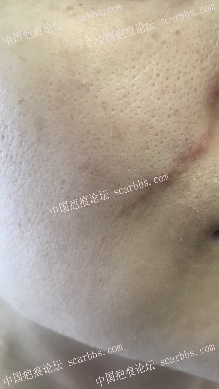 陈立彬医生脸部疤痕手术5个月记录 脸部疤痕,切缝手术,记录恢复