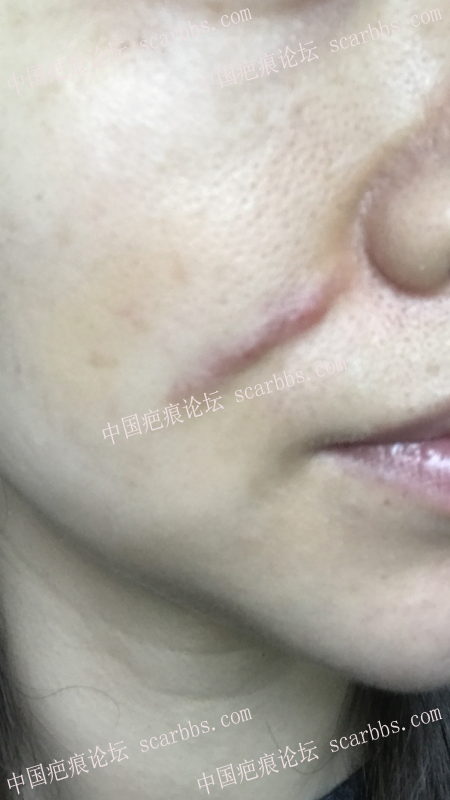 陈立彬医生脸部疤痕手术5个月记录 脸部疤痕,切缝手术,记录恢复