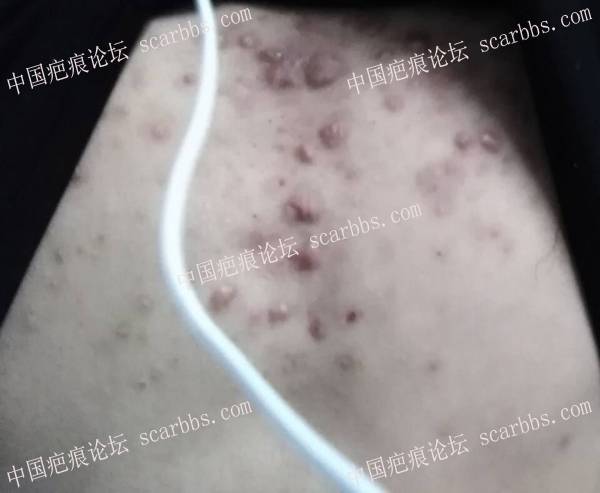 疤痕疙瘩4年，明天2月5号去北京疤康记录贴 胸部疤痕疙瘩,北京疤康,记录