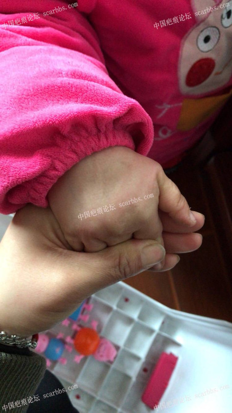 宝宝手指手背烫伤，抗疤26天，坚持下去！ 