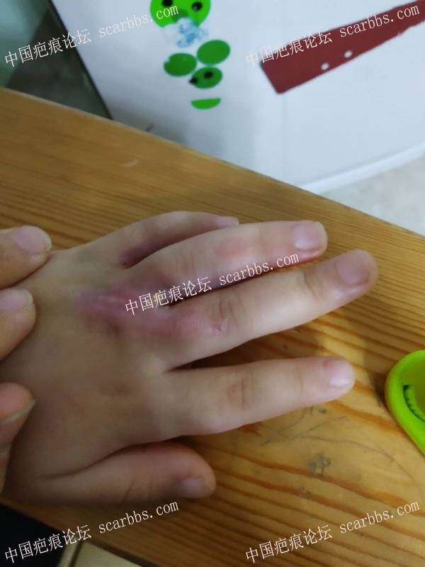 (李高令)五岁女孩被跑步机磨伤手指一个月(厦门) 