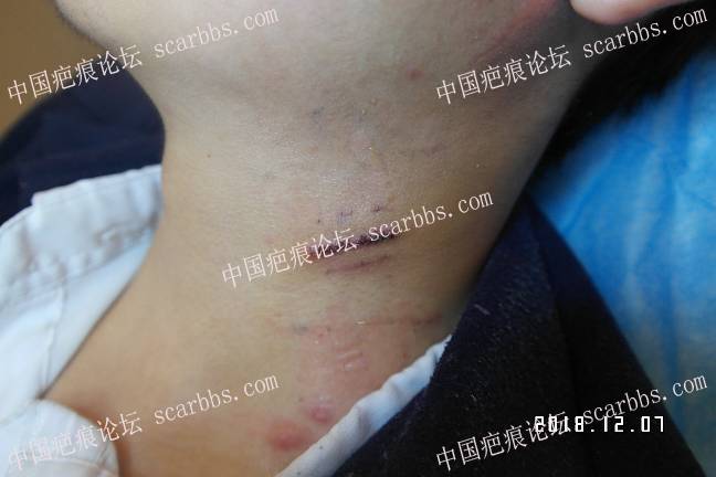 颈部疤痕在杨教授这里找到了祛疤终点站 颈部疤痕,手术切除,好美整形