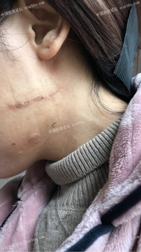 11月22号杨东运教授做的左脸疤痕切缝 面部手术疤痕,切缝修复,杨东运教授