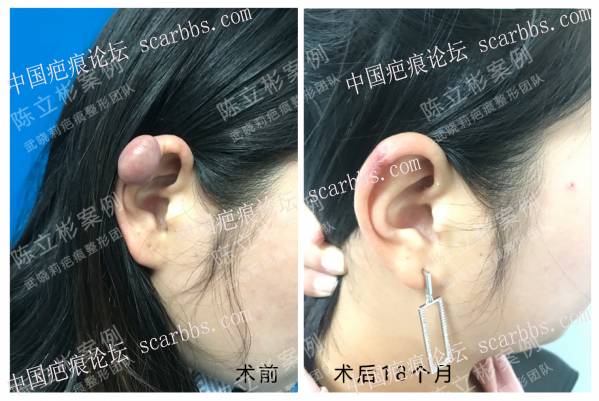 耳部疤痕疙瘩术后1年半复诊记录 耳部疤痕疙瘩,术后放疗,加压护理