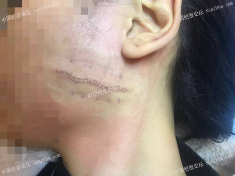 11月22号杨东运教授做的左脸疤痕切缝 面部手术疤痕,切缝修复,杨东运教授