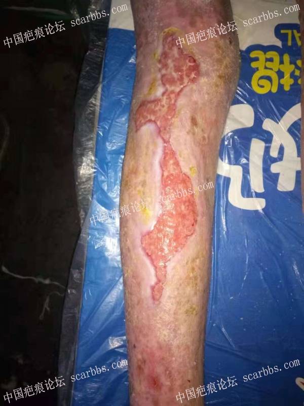 李高令2018年接治化学烧伤百分之三十五的病人(潍坊) 