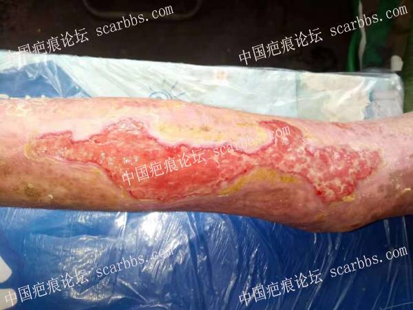 李高令2018年接治化学烧伤百分之三十五的病人(潍坊) 