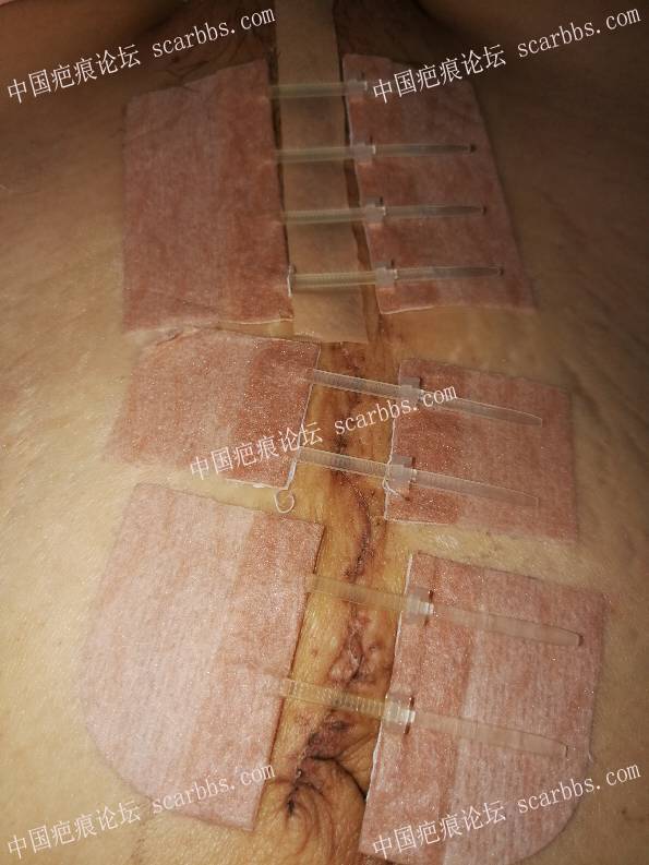 剖腹产巨型疤痕切除+放疗术后 剖腹产竖切疤痕,手术切除,术后放疗