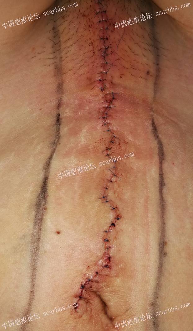 剖腹产巨型疤痕切除+放疗术后 剖腹产竖切疤痕,手术切除,术后放疗
